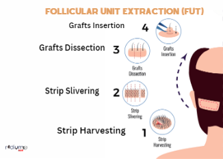 Follicular-Unit-Extraction-FUT-grafile
