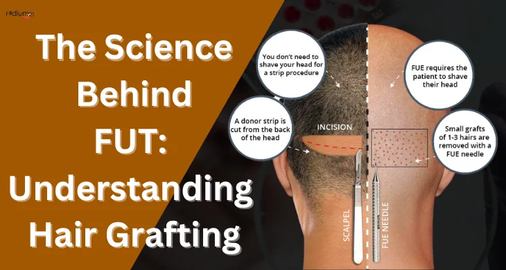 the science behind fut understanding hair grafting