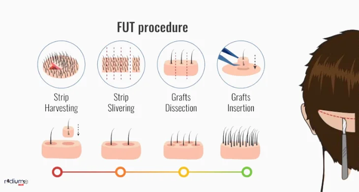 breaking down the FUT procedure step by step